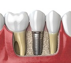 Close-up of an unrestored dental implant in Midlothian, TX