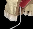 a digital illustration of a sinus lift in Midlothian