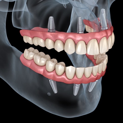 3D illustration of human skull with all-on-4