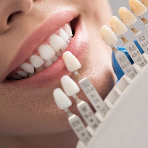 Smile compared with porcelain veneer shade chart