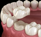 Dental crown