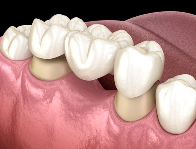 dental bridge in Midlothian replacing a single missing tooth