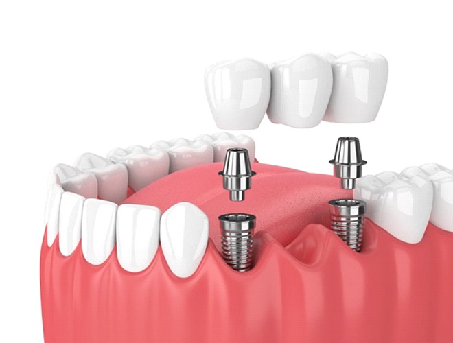 two dental implants securing a dental bridge into place