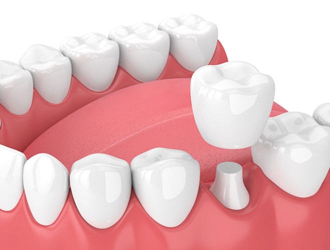 Illustration of dental crown in Midlothian being placed on tooth