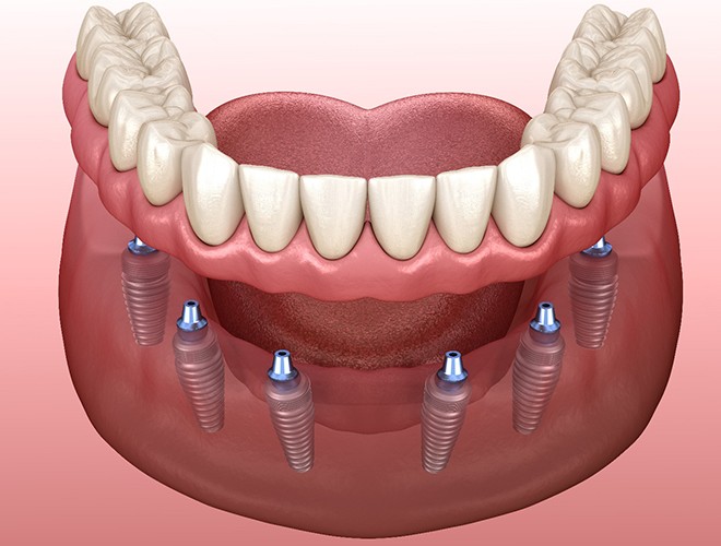 Illustration of implant-retained dentures