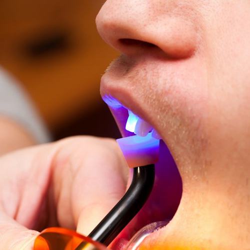 close up of man getting tooth-colored filling hardened with curing light 