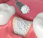 an illustration of a bone graft in Midlothian