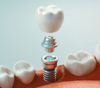an illustration of the parts of dental implants