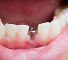 closeup of dental implant in person’s mouth