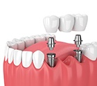 two dental implants with a dental bridge 