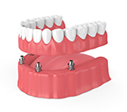 four dental implants holding a full denture 