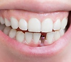 person smiling with a visible dental implant 