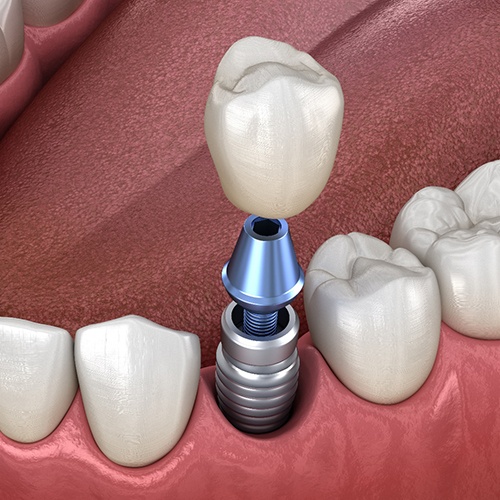 single dental implant with crown 