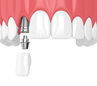 single dental implant with crown in upper arch 