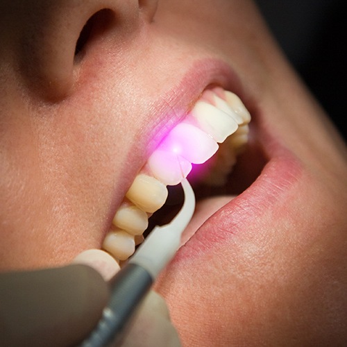 Patient receiving laser periodontal therapy