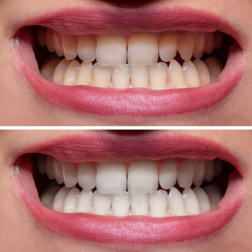 Before and after full mouth reconstruction in Midlothian