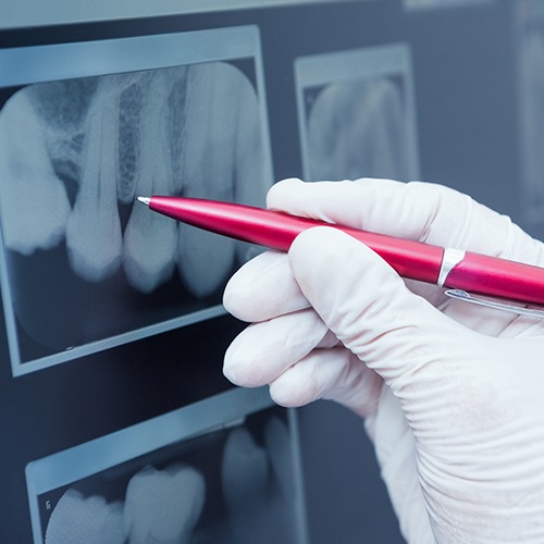 Pen pointing at dental x-ray image