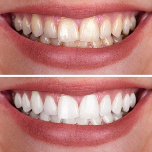 close-up of teeth before and after being whitened by a cosmetic dentist in Midlothian, TX