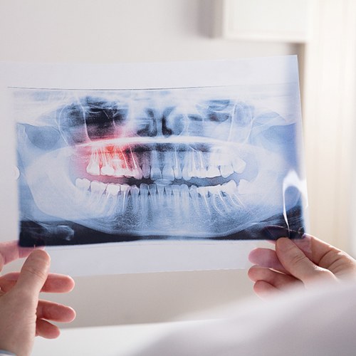 X-ray with molars highlighted in red