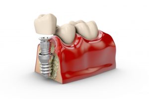 dental implants 3D illustration 