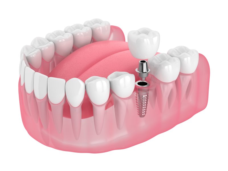 graphic demonstrating a dental implant