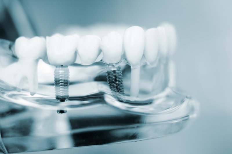 plastic model of dental implants