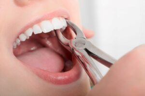 Nose to chin view of forceps grasping patient's tooth for extraction