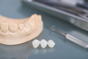 Pristine dental bridge sitting in a dental lab next to a wax model of a lower arch